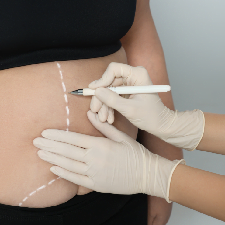 Gastric Bypass, gastric bypass vs sleeve, gastric bypass vs sleeve, bypass gastrico , gastric sleeve vs bypass, mini gastric bypass, sleeve vs gastric bypass, gastric bypass surgery cost, gastric bypass surgery cost UK, mini gastric bypass cost uk, what is gastric bypass surgery, what is a gastric bypass