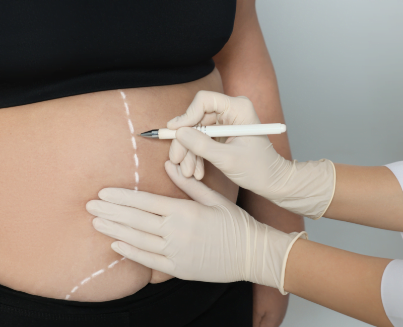 Gastric Bypass, gastric bypass vs sleeve, gastric bypass vs sleeve, bypass gastrico , gastric sleeve vs bypass, mini gastric bypass, sleeve vs gastric bypass, gastric bypass surgery cost, gastric bypass surgery cost UK, mini gastric bypass cost uk, what is gastric bypass surgery, what is a gastric bypass